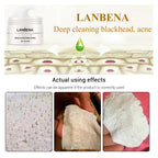 Blackhead Nasal Membrane Sucking Blackhead Tearing To Remove Acne Lootquake LLC