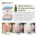 BREYLEE Acne Treatment Serum Face Facial Anti Acne Scar Removal Cream Skin Care Whitening Repair Pimple Remover For Acne Lootquake LLC