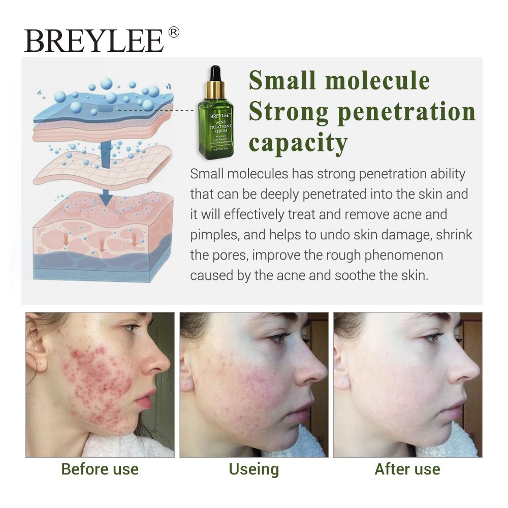 BREYLEE Acne Treatment Serum Face Facial Anti Acne Scar Removal Cream Skin Care Whitening Repair Pimple Remover For Acne Lootquake LLC