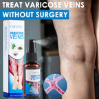 30ml Varicose Vein Spray Multi-Purpose Knee And Leg Care Spray Promote Blood Circulation Lootquake LLC