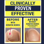 Nonyx Fungal Nail Clarifying Gel Clears Out Keratin Debris Where Nail Fungus Thrives 4 oz EasyOptionXY LLC