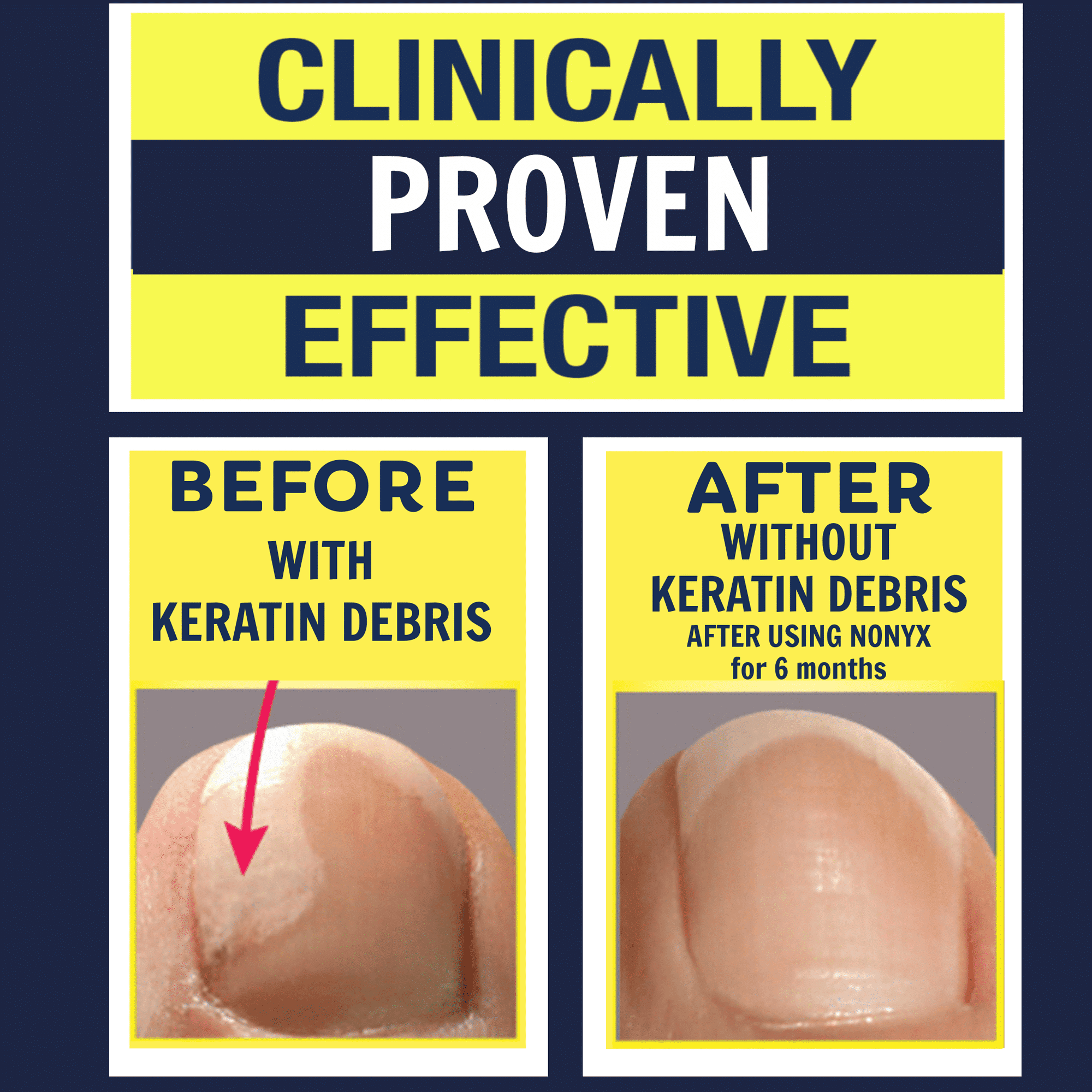 Nonyx Fungal Nail Clarifying Gel Clears Out Keratin Debris Where Nail Fungus Thrives 4 oz EasyOptionXY LLC