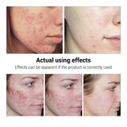 BREYLEE Acne Treatment Serum Face Facial Anti Acne Scar Removal Cream Skin Care Whitening Repair Pimple Remover For Acne Lootquake LLC