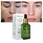 BREYLEE Acne Treatment Serum Face Facial Anti Acne Scar Removal Cream Skin Care Whitening Repair Pimple Remover For Acne Lootquake LLC
