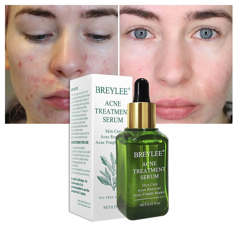 BREYLEE Acne Treatment Serum Face Facial Anti Acne Scar Removal Cream Skin Care Whitening Repair Pimple Remover For Acne Lootquake LLC
