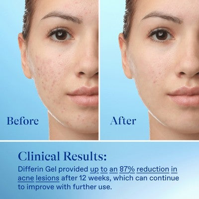 Differin Retinoid Acne Treatment; Adapalene Gel 0.1% 45g/1.6oz - New This is Beauty US
